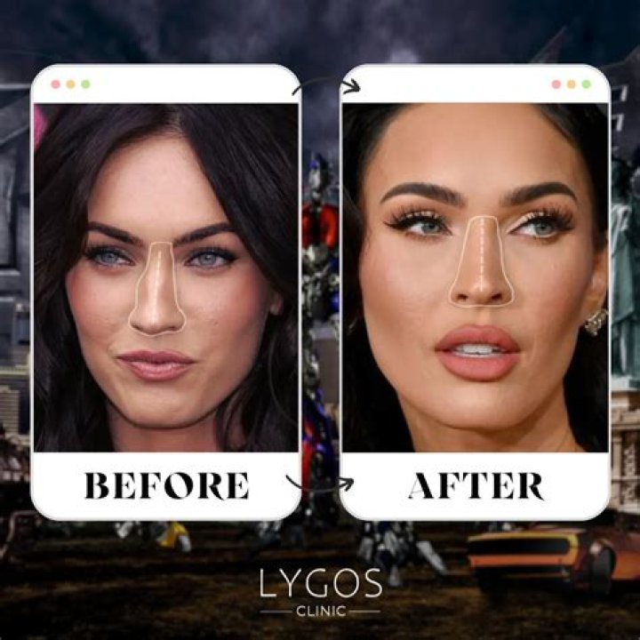 Unveiling The Transformation: Priyanka Chopra's Pre-Rhinoplasty Journey